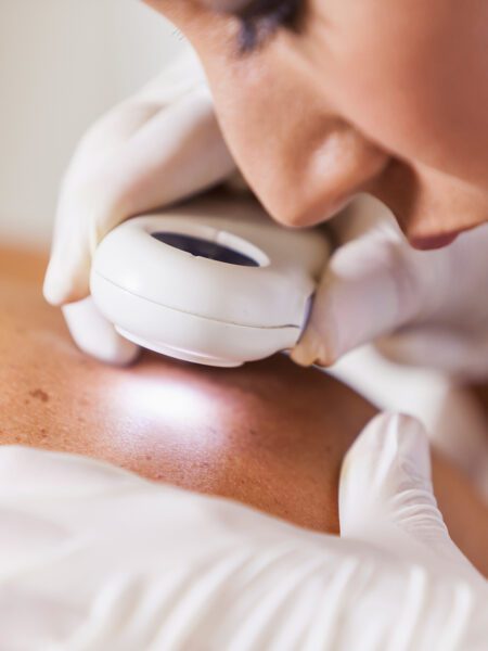 Female dermatologist (30s) examining male patient's skin with dermascope, carefully looking at a mole for signs of skin cancer.